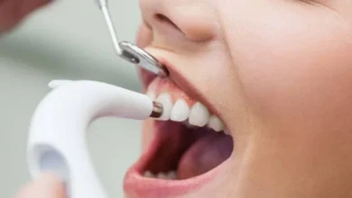 teeth scaling and polishing