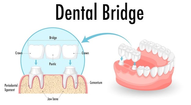 The Role of Dental Bridges in Improving Oral Health and Aesthetic Appearance in Sebring