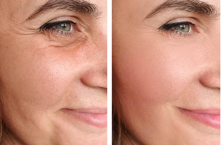Cheek Augmentation: A Non-Surgical Solution for a Youthful Lift
